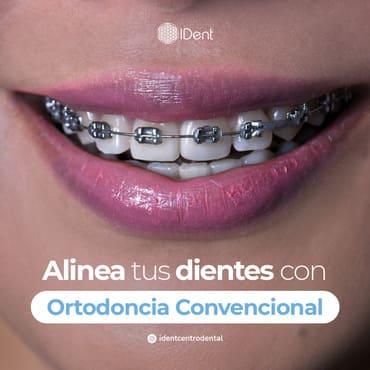 Ortodoncia con Brackets