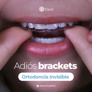 Ortodoncia Invisible